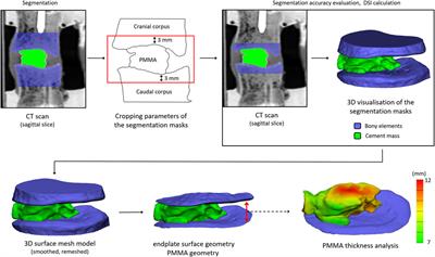 Biomechanical consequences of cement discoplasty: An in vitro study on thoraco-lumbar human spines